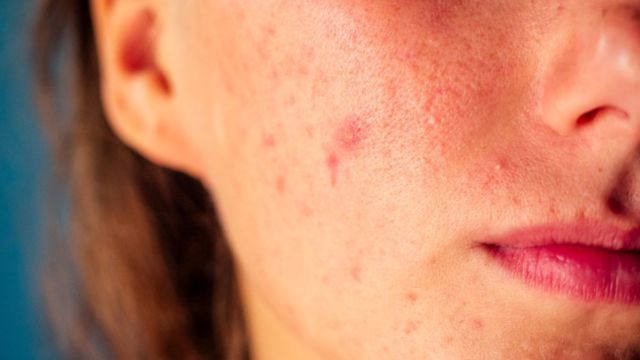 5 Tanda Sabun Muka Tidak Cocok yang Perlu Diketahui 15 Tanda Sabun Muka Tidak Cocok
