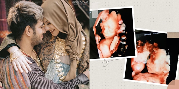 Mengenal Twin to Twin Transfusion Syndrome; Penyebab Bayi Kembar Irish Bella – Ammar Zoni Meninggal