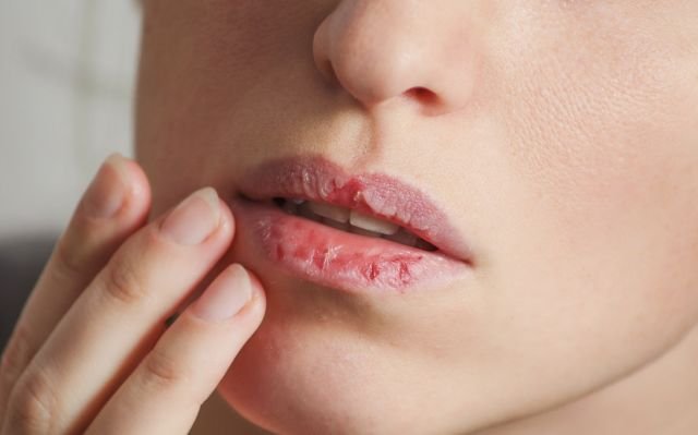 manfaat madu untuk bibir