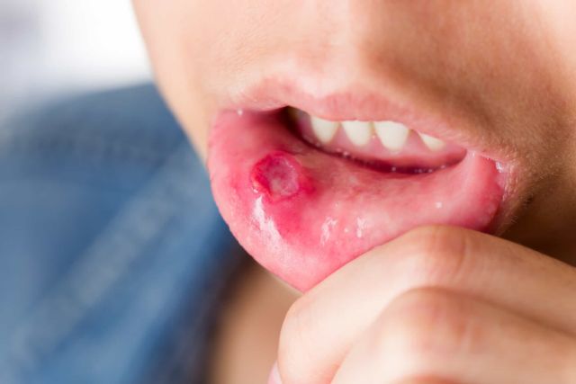 manfaat madu untuk bibir