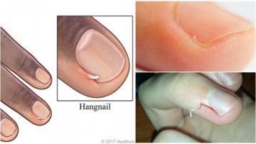 Cara Mengatasi Hangnail, Kulit Lancip yang Sering Nongol di Dekat Kuku Jari Tangan atau Kaki