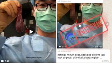 Video Kantong Empedu Berisi Butiran Boba Ternyata Hoaks, Guys! Yuk, Cek Faktanya Bareng~