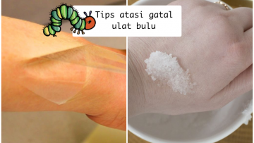 Bukan Digaruk, Ini 6 Cara Atasi Gatal Gara-gara Ketempelan Ulat Bulu. Sebelum Menjalar Lo!