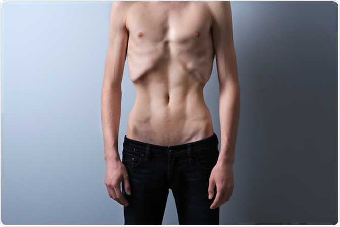 Male with anorexia
