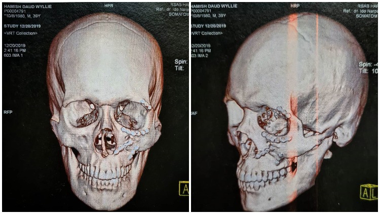 Sempat Trauma karena Kecelakaan, Hamish Daud Unggah Foto X-Ray Wajahnya. Ternyata Penuh Baut
