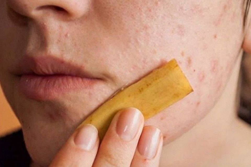 5 Manfaat Kulit Pisang untuk Wajah dan Aturan Pakainya. Efektif Tumpas Keriput dan Jerawat