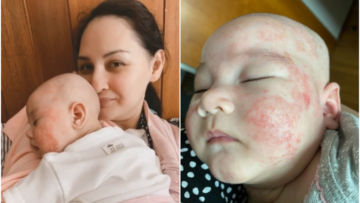 Alami Dermatitis Atopik, Wajah Bayi Mona Ratuliu Dipenuhi Ruam Merah. Sang Ibu Putuskan Diet Sehat