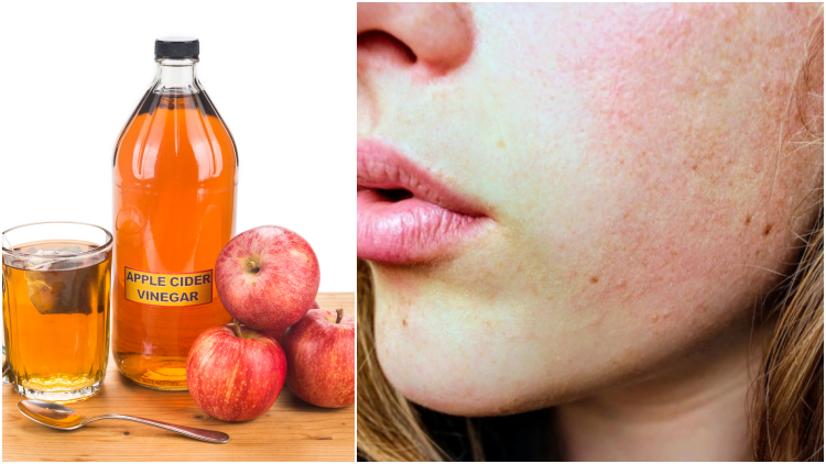 6 Efek Samping Penggunaan Toner Cuka Apel yang Kurang Tepat