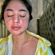 Sempat Tampilkan Wajah Penuh Ruam hingga 2 Kali Positif Corona, Begini Kondisi Terbaru Dewi Perssik