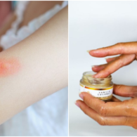 8 Cara Menghilangkan Bekas Gigitan Nyamuk, Kurangi Gatal dan Bintik Hitam yang Mengganggu