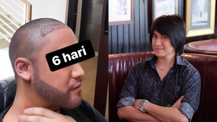 Tampil dengan Kepala Plontos, Kevin Aprilio Jalani Transplantasi Rambut. Akui Insecure