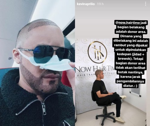 Tampil dengan Kepala Plontos, Kevin Aprilio Jalani Transplantasi Rambut. Akui Insecure