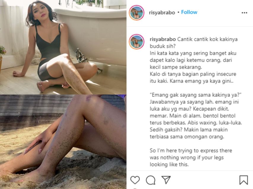 Kaki Banyak Luka Dibilang Budukan, Selebgram Risya Brabo: Nggak Ada yang Salah dengan itu