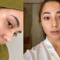 4 Seleb Hits yang Pede Pamer Bare Face dan Cerita Masalah Kulitnya. Jerawatan itu Manusiawi!