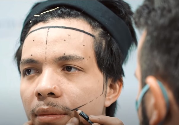 Atta Halilintar Ikut Transplantasi Rambut, Ingin Perbaiki Jidat yang Lebar