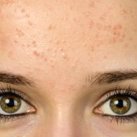 8 Cara Menghilangkan Bruntusan di Dahi, dari Cuci Muka Sampai Eksfoliasi