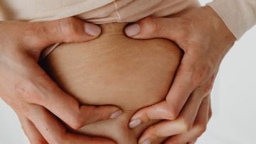 Kenali 7 Penyebab Stretch Mark, Nggak Cuma karena Kehamilan