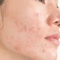 Kandungan Skincare yang Aman dan Ampuh untuk Memberantas Jerawat
