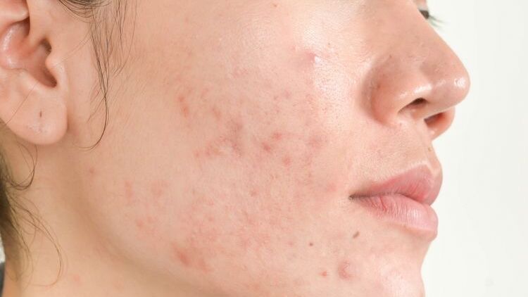 Kandungan Skincare yang Aman dan Ampuh untuk Memberantas Jerawat