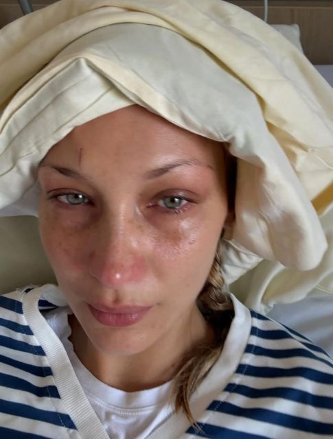 lyme disease- penyakit kronis