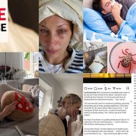 5 Fakta Mengejutkan Seputar Lyme Disease Bella Hadid yang Wajib Diketahui Sebagai Bentuk Awareness