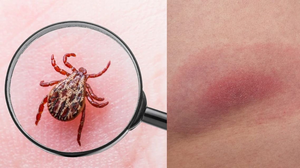 lyme disease-penyebab