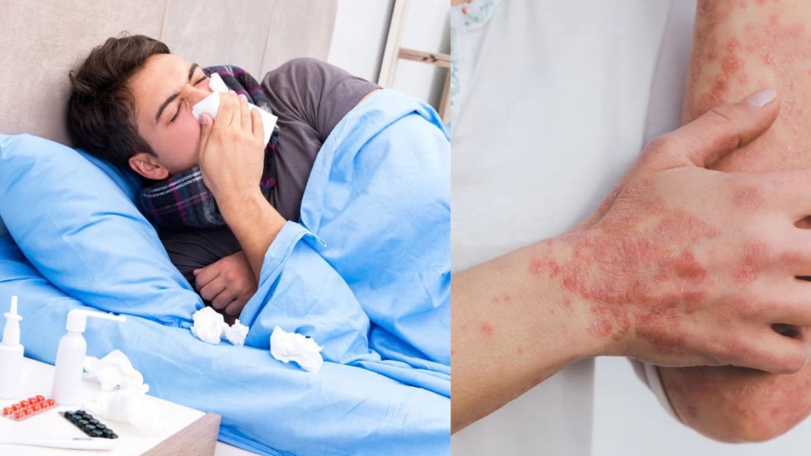 Lyme Disease-gejala awal spt flu